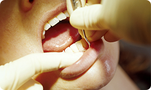 歯周病検査項目