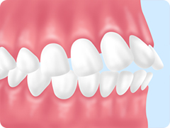 上顎前突（出っ歯）