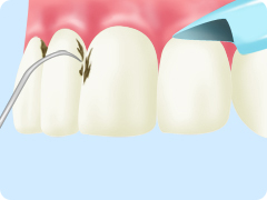 歯石取り
