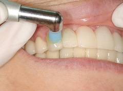 歯のクリーニング（PMTC/プロフェッショナル・メカニカル・トゥース・クリーニング）