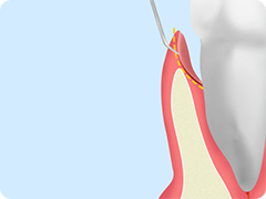 歯周ポケットそうは術