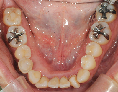 implant治療前_下顎